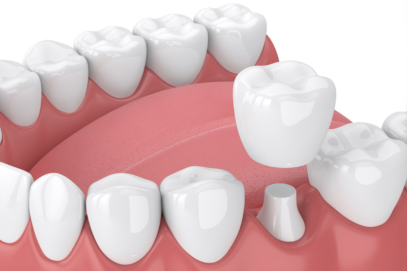 Dental Crowns in Ozark