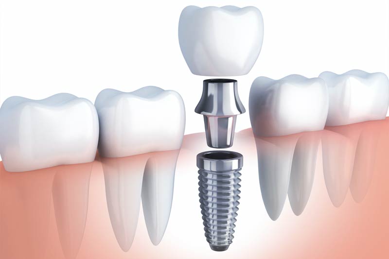 Implants Dentist in Ozark